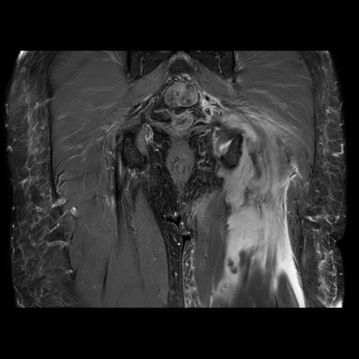 Coronal MRI image from Adam’s scan on 14 July 2026