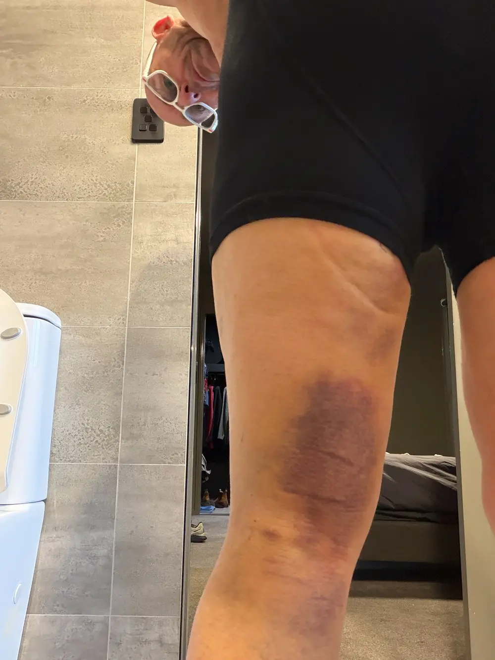Bruising on the back of Adam’s left thigh on Monday morning