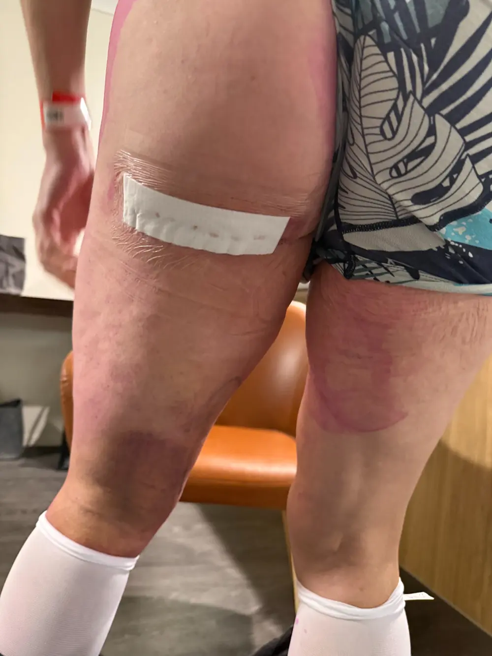 Post-operative dressing on the back of Adam’s left upper thigh after returning home